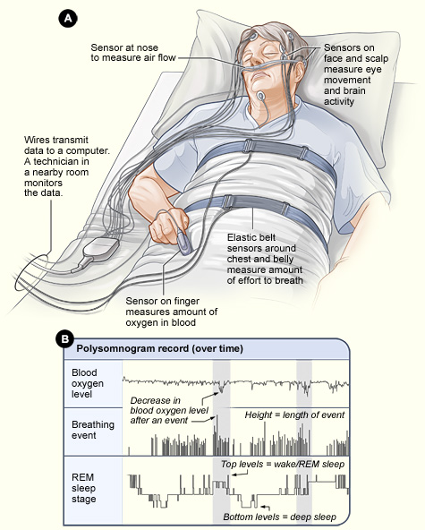 A labeled medical diagram of a sleep study: a person asleep in bed with sensors on the face, scalp, chest and finger, wires running to a computer, and beneath it a chart of blood oxygen, breathing and REM sleep stages through the night