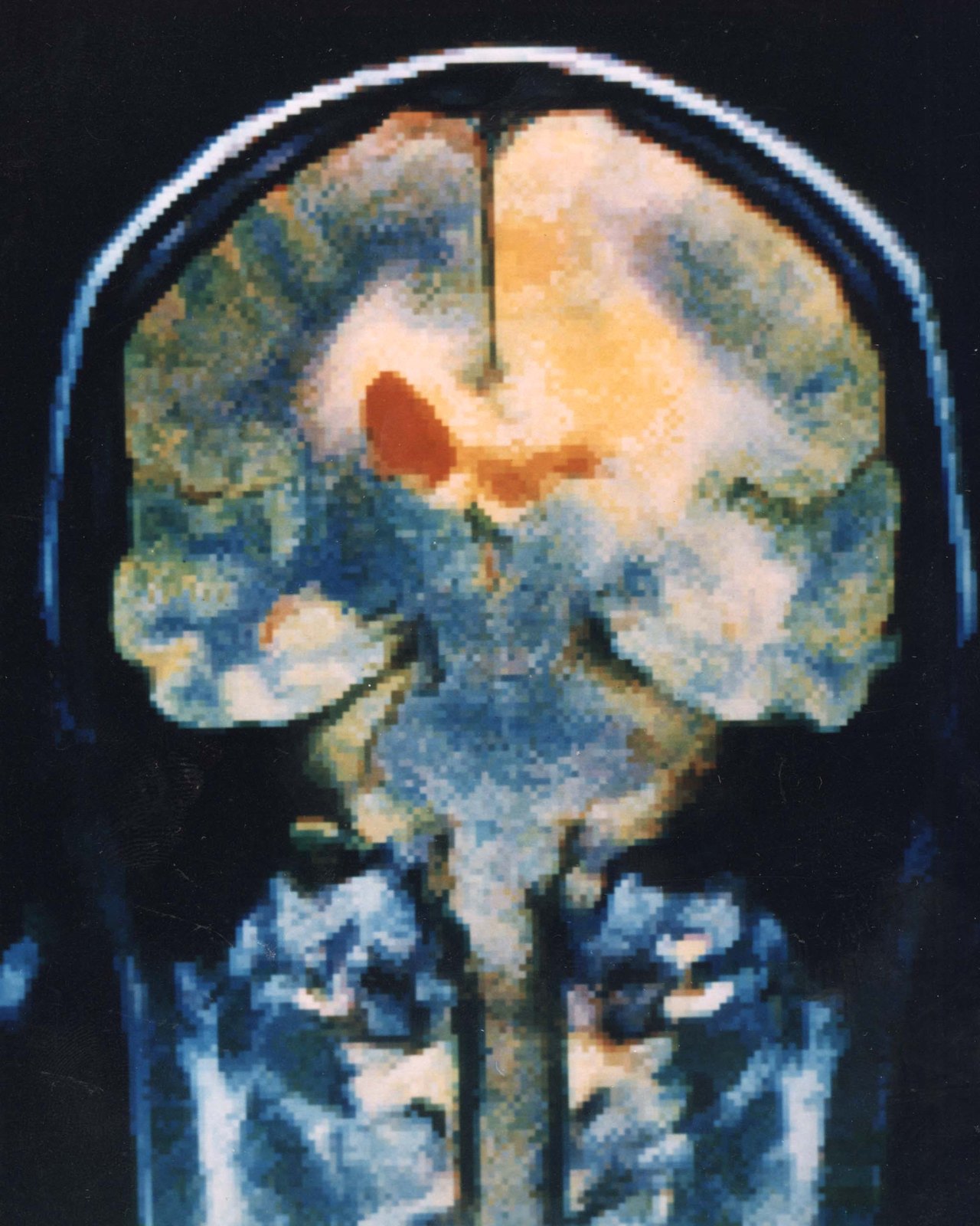 A colored magnetic resonance scan of a human head, showing a slice through the brain and neck in orange, cream and blue