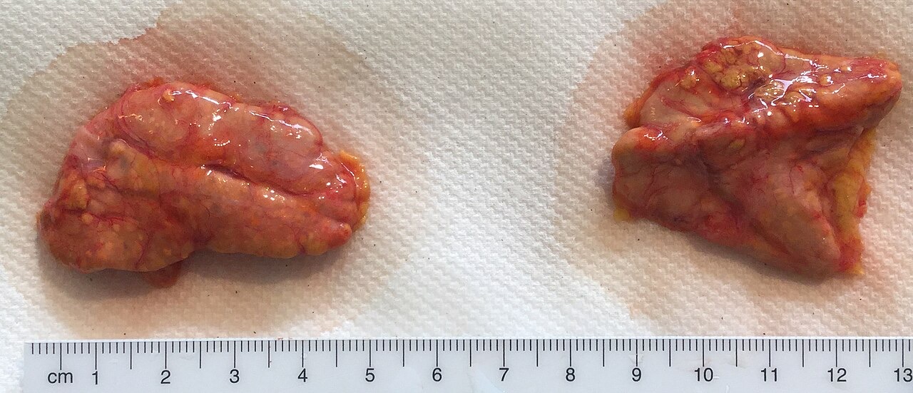 Two small glossy orange-tan human glands laid on white surgical paper above a centimeter ruler; each gland is roughly five centimeters across