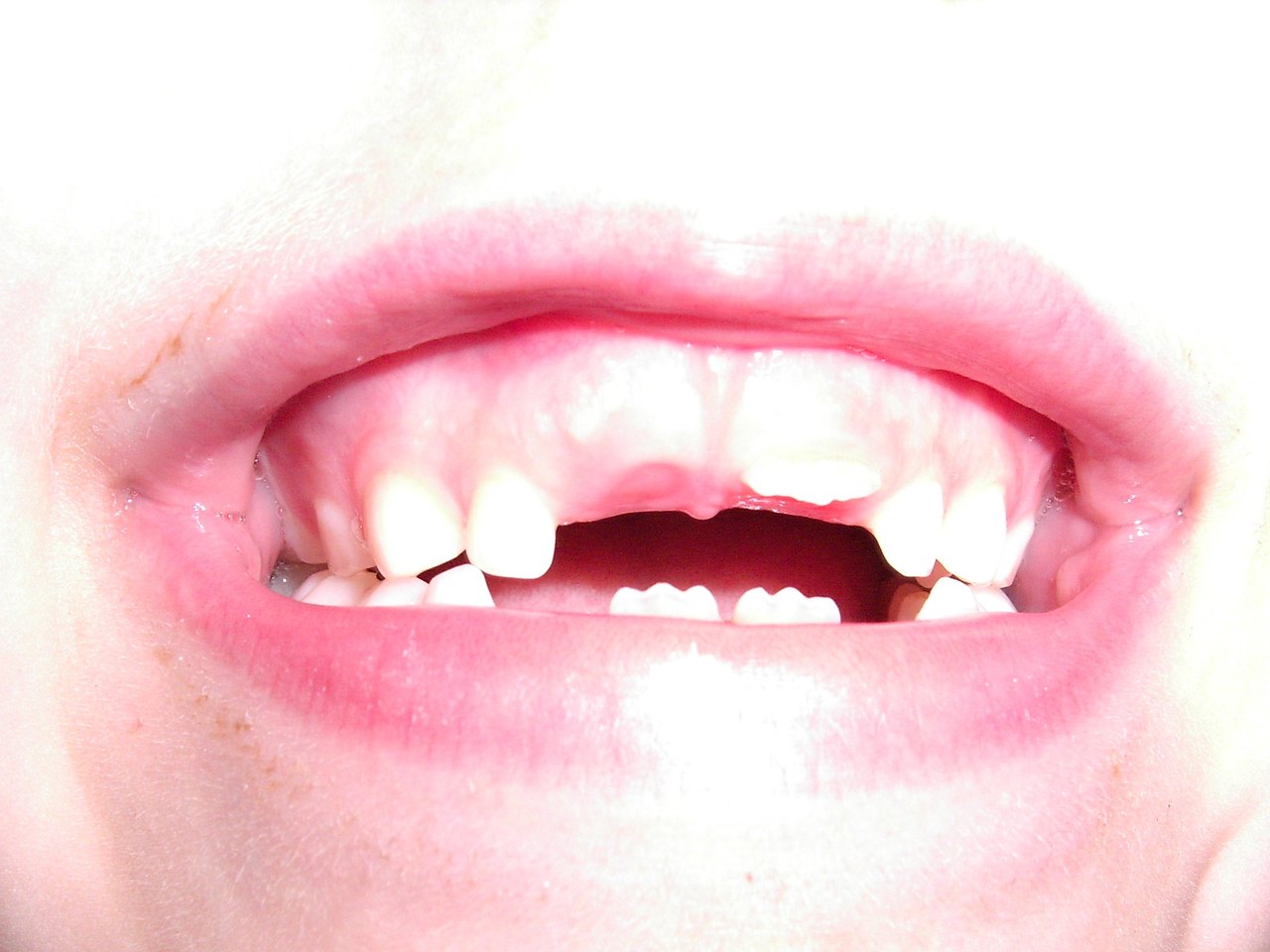 A close photograph of a child's open mouth showing small baby teeth along the top, a gap where one has fallen out, and a larger adult tooth coming through below