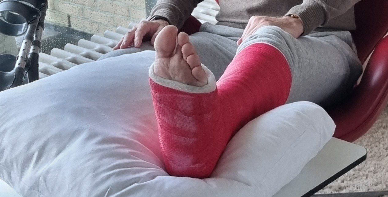 A bright red plaster cast on a lower leg and foot, resting on a white cushion, with the toes left uncovered and a crutch leaning nearby